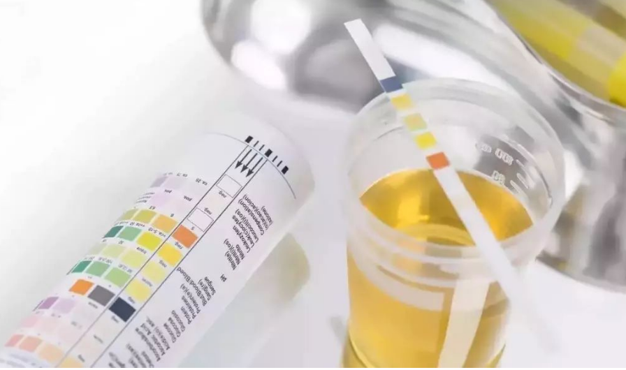 尿检需要注意什么