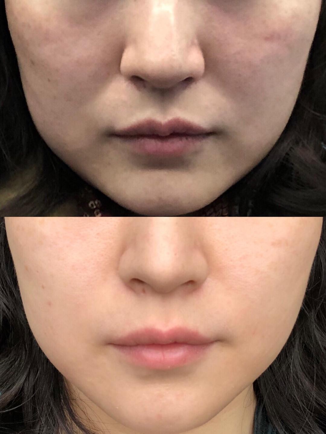 热玛吉做一次需要多少钱呢？？