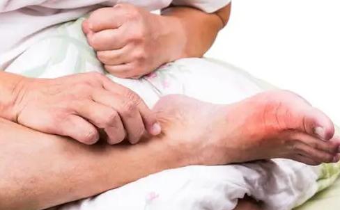 尿酸多少在正常范围?