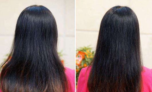 植发费用大概是多少费用