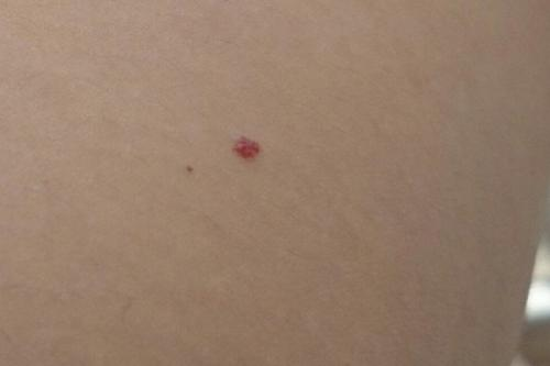 身上长小红痣是怎么回事