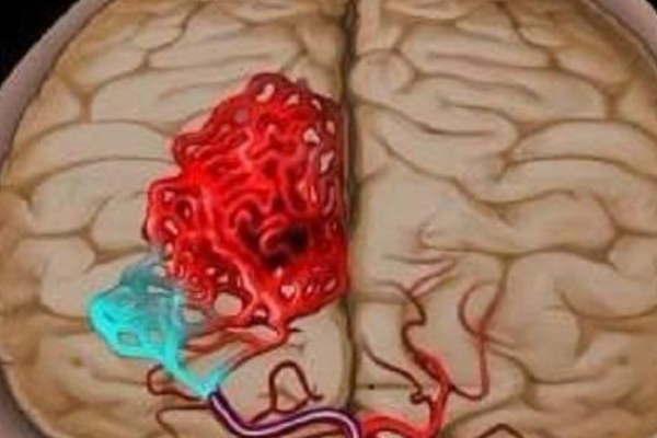 脑淤血什么概念