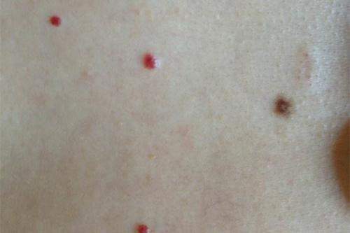 身上长小红痣是怎么回事