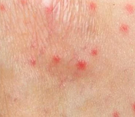 手上有小红点是怎么回事?