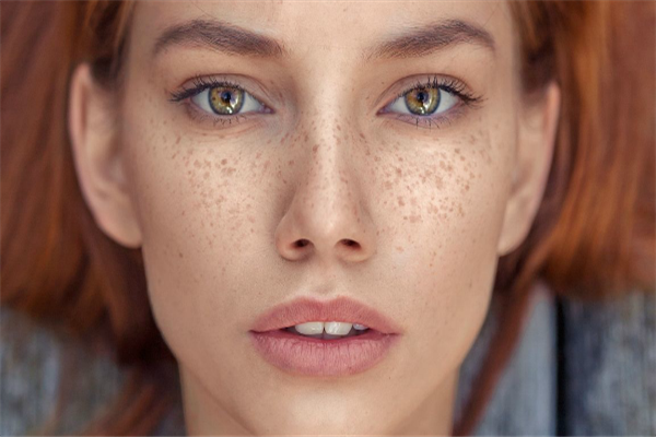 脸上黄褐斑怎么去除效果最好