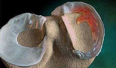 詹姆斯儿子半月板撕裂,半月板撕裂一般是有什么原因造成的?