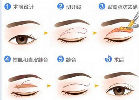 怎么才能变成双眼皮