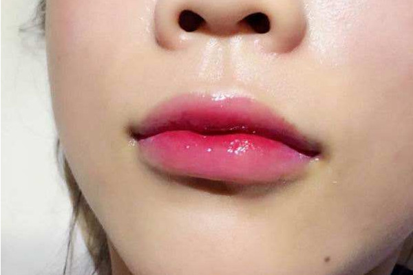 漂唇的危害有哪些?