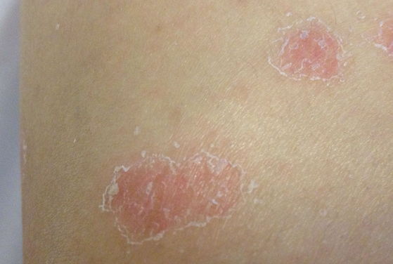 皮癣的常见病症