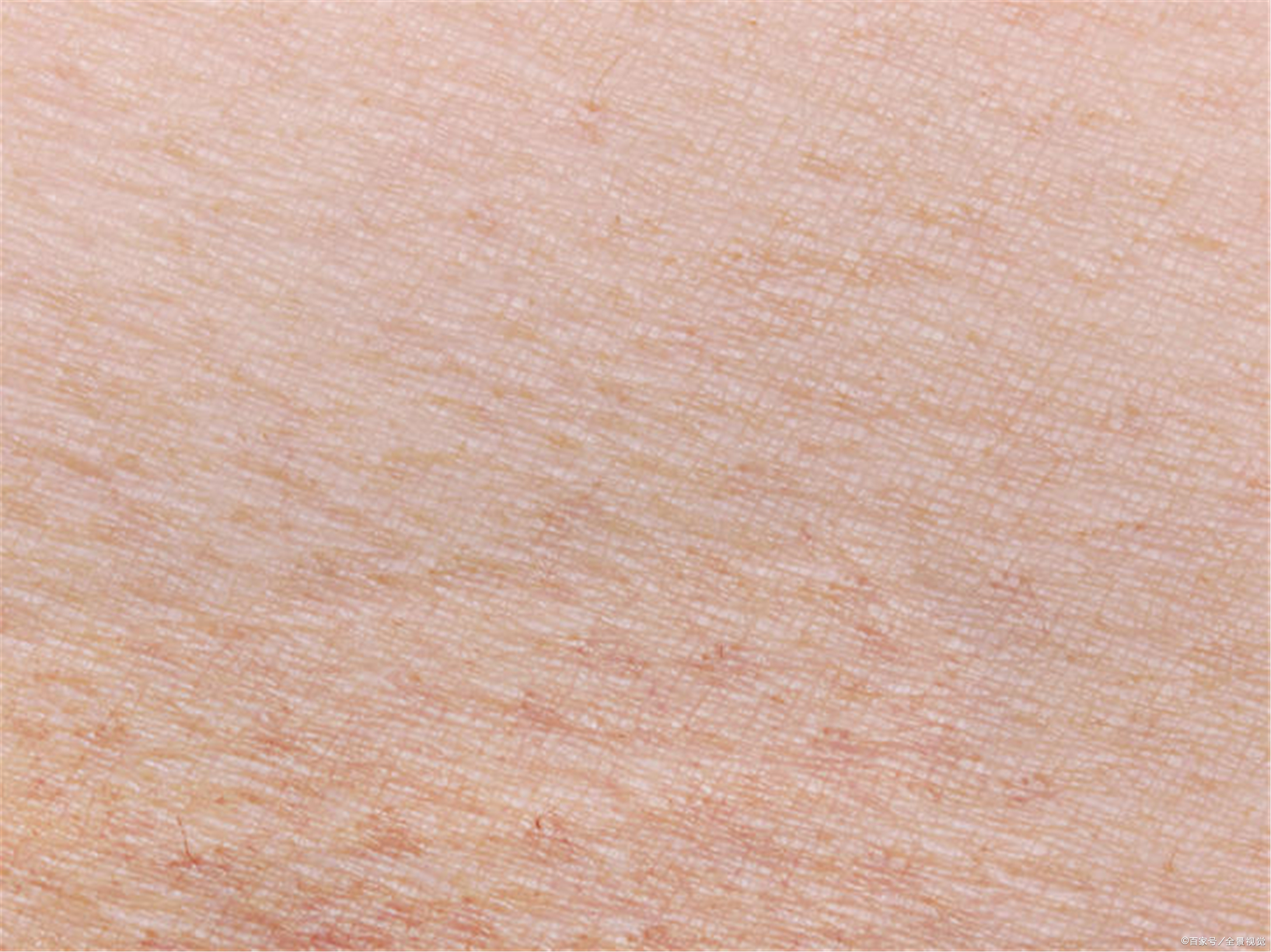 扁平疣怎么治疗？