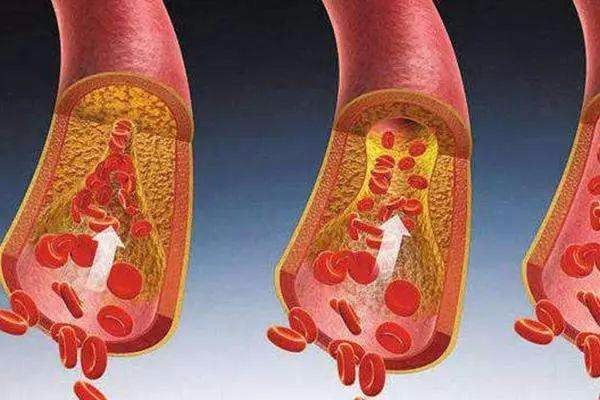 用微型机器人清理血管真的可行吗?