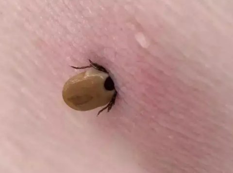 蜱虫病一般指的是人粒细胞无形体病,感染后身体会出现哪些症状?
