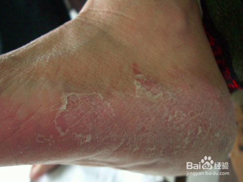 脚底脱皮是怎么回事