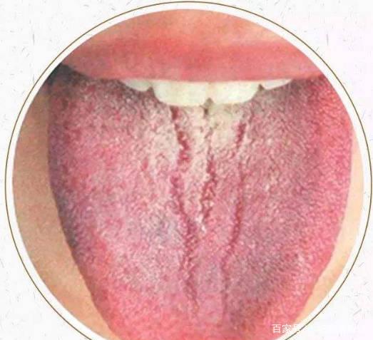 舌中有裂缝是什么原因呢?