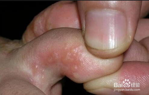 脚底脱皮是怎么回事
