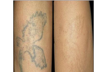 洗纹身后什么样子