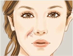 澳洲祛疤膏dermatix使用方法