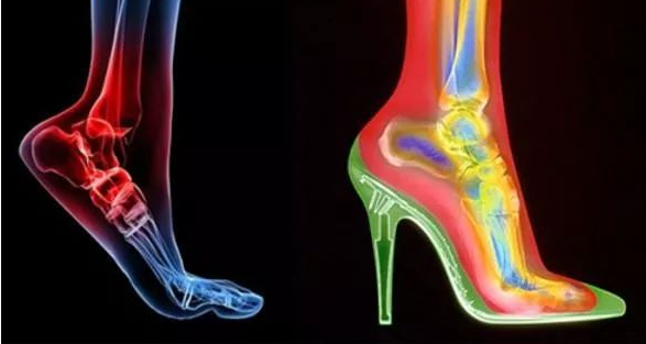 踝关节背屈、趾屈分别是什么意思啊。