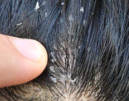如何去头屑最快最有效