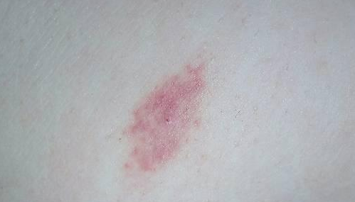 吻痕怎么吸出来的?