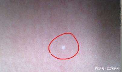 身上长白斑什么原因