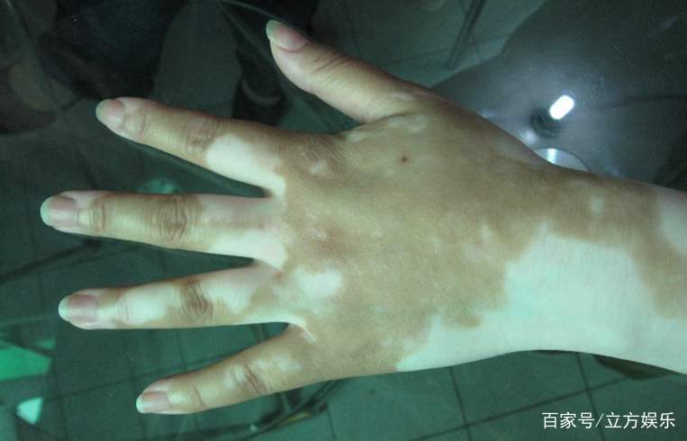 身上长白斑什么原因