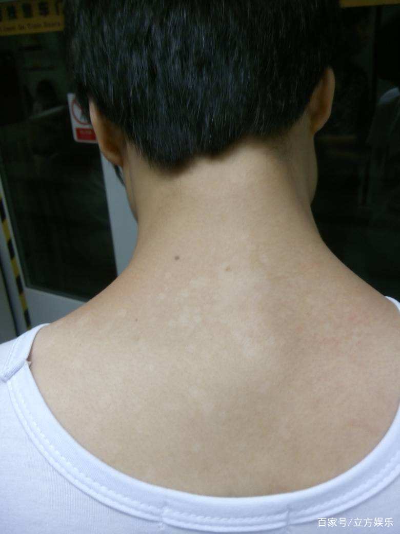 身上长白斑什么原因