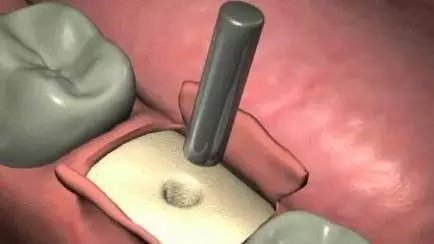 种植牙的过程有几个步骤?