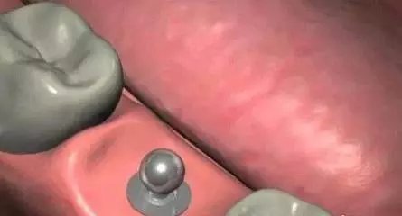 种植牙的过程有几个步骤?