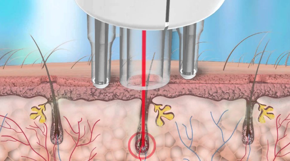 脱毛用哪种方法好？