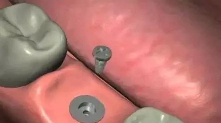 种植牙的过程有几个步骤?