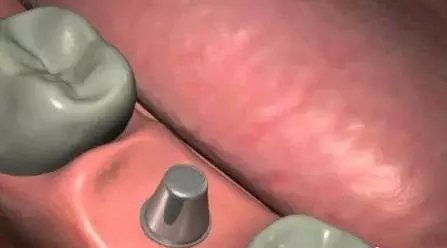 种植牙的过程有几个步骤?