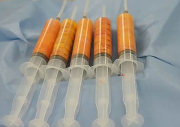 面部自体脂肪移植