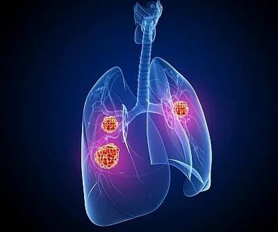 人大代表建议将肿瘤筛查纳入医保，你支持吗？