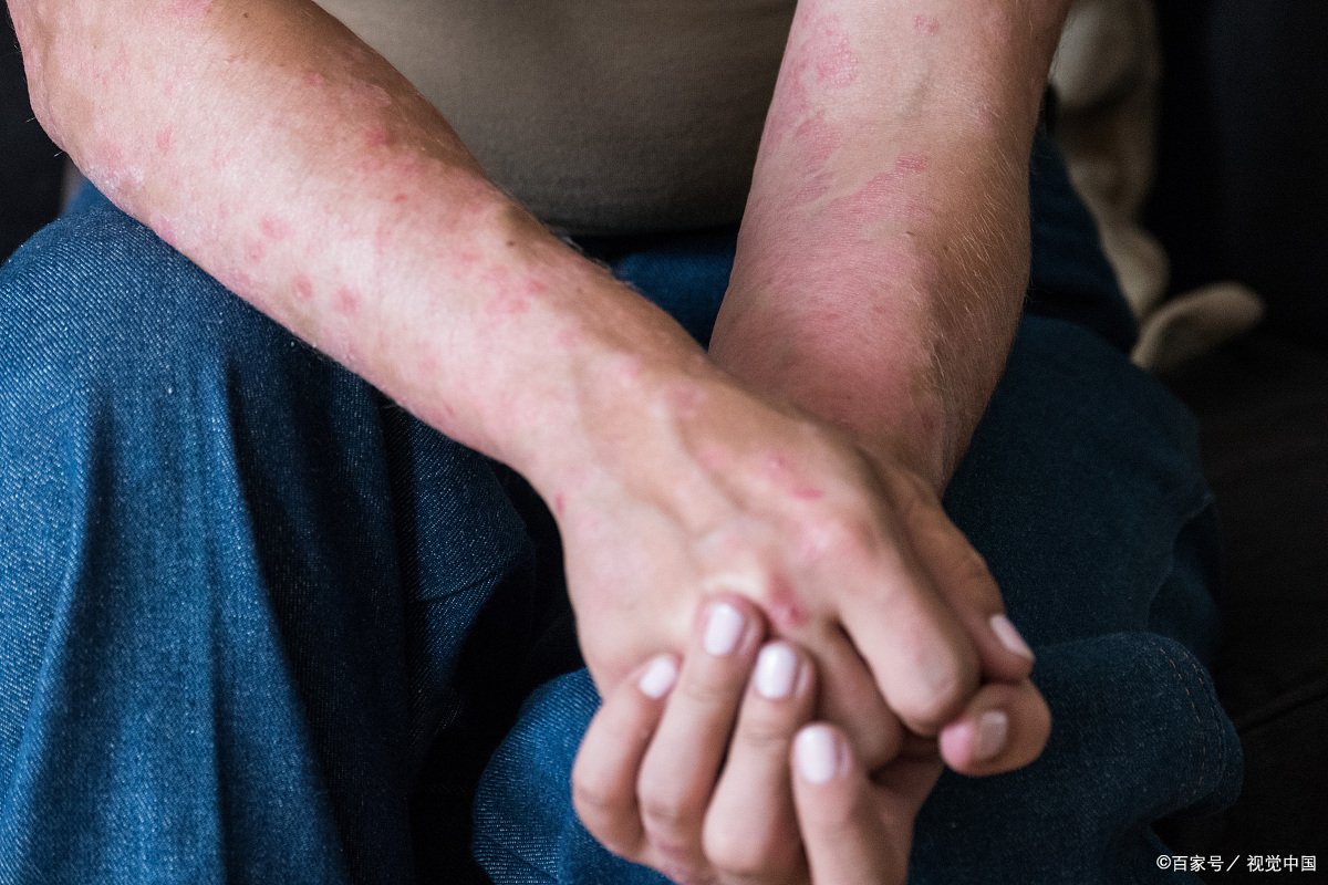 慢性荨麻疹怎么能根治