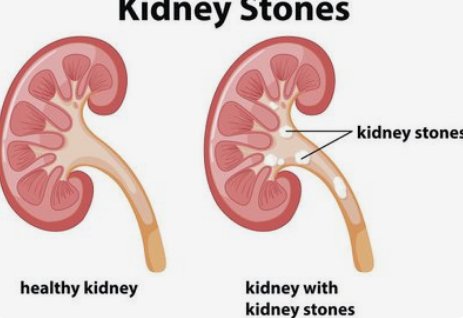肾结石痛起来最有效的止痛方法？