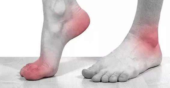 治疗痛风的最佳方法是什么?