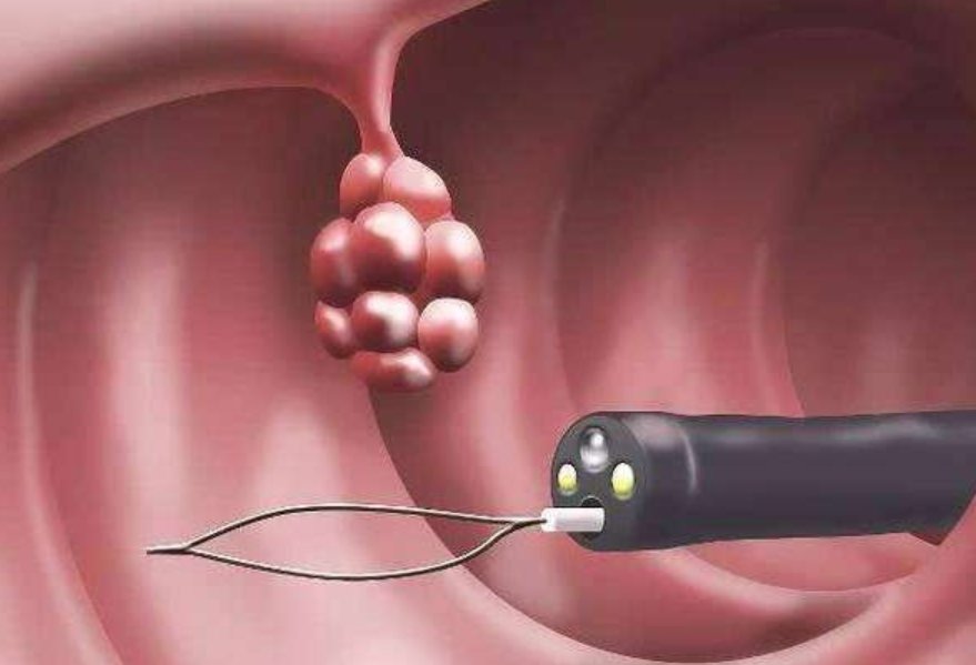 肠息肉的症状是什么