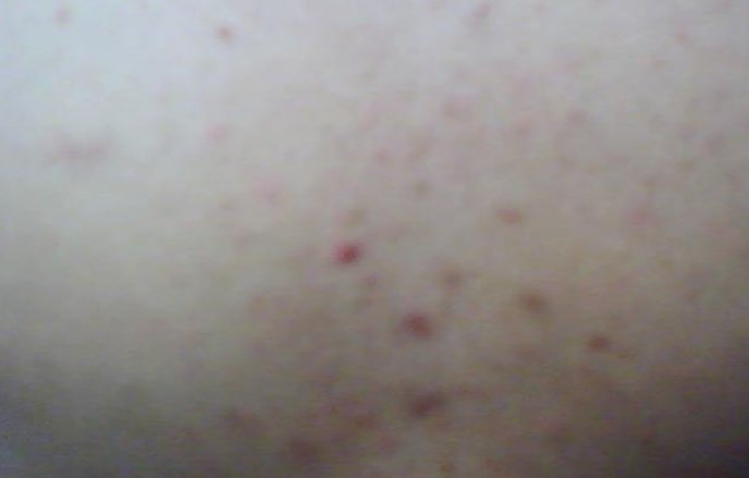 身上起疙瘩，越挠越痒。