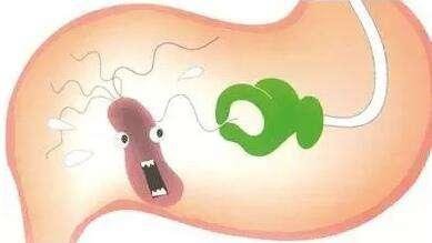 请问治疗幽门螺杆菌感染的四联疗法是哪四种药