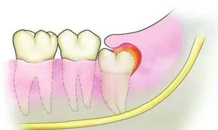 牙齿为什么会痛呢?