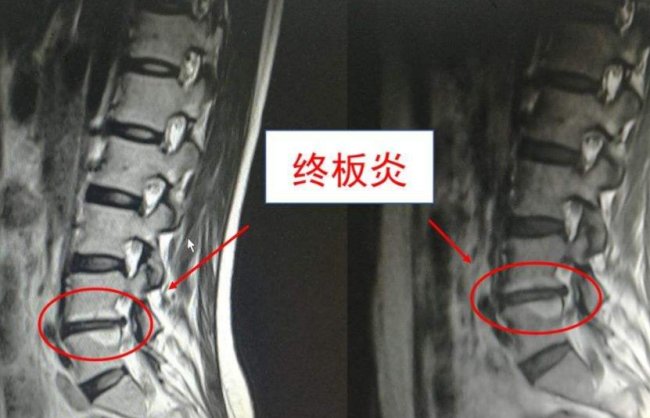 腰椎间盘突出 怎么治疗