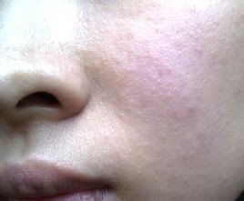 脸上老是长痘痘是什么原因啊?