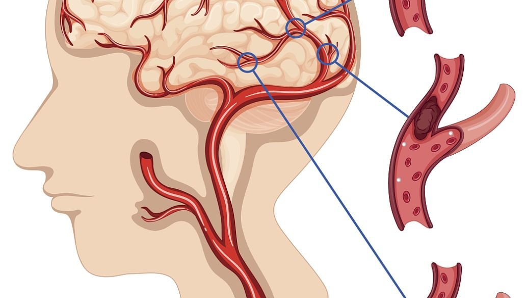 脑梗前兆是什么?