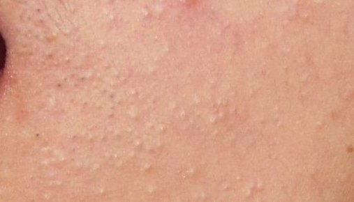 粉刺图片，怎么判断自己是不是封闭性粉刺？