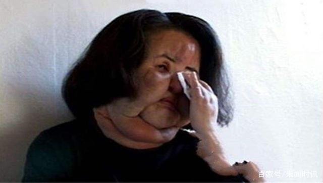 韩国电风扇阿姨韩慧景，沉迷整容变怪物？整容可能变毁容吗？