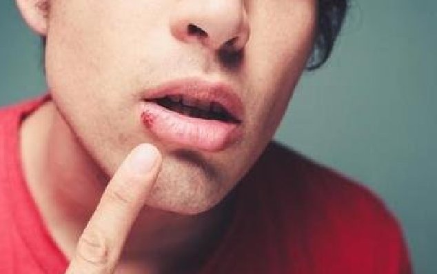 嘴角长疱疹是什么原因？