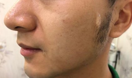 脱胡子能永久脱毛吗？