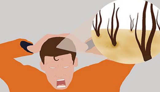 治疗斑秃的好方法？