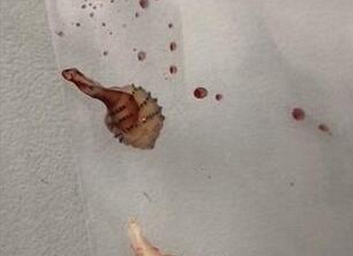 女子小腿取出活虫怎么回事